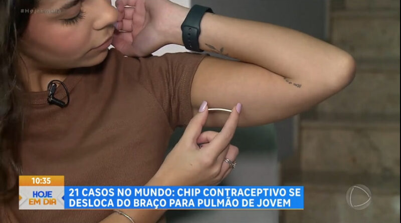 Jovem passa por cirurgia delicada após chip contraceptivo se deslocar do braço para o pulmão – RecordTV